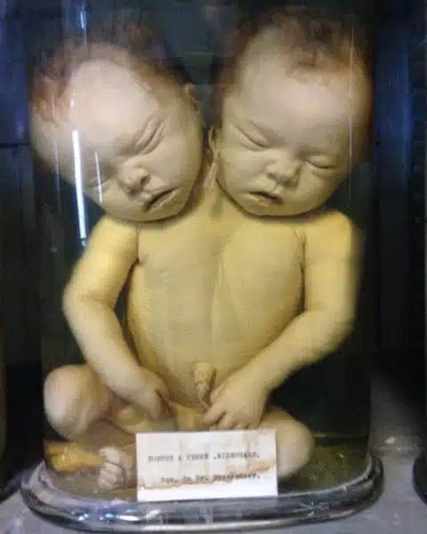 Photo de fœtus exposé au conservatoire de l'anatomie à Montpellier